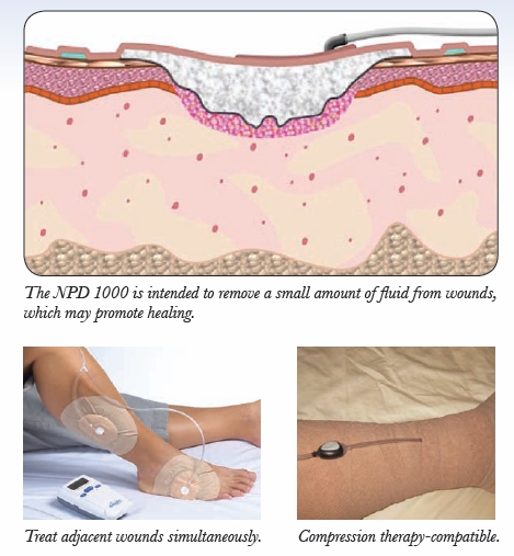 negative pressure wound therapy